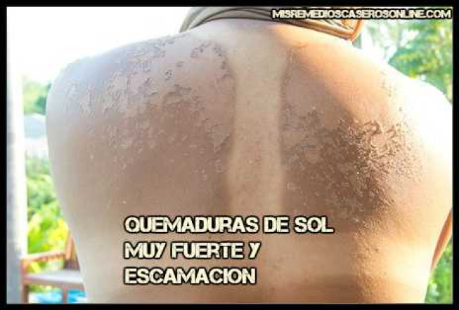 Remedios caseros para quemaduras de sol